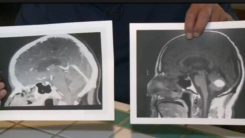 Médicos en shock: un hombre le rezó a Dios y desapareció un tumor cerebral que tenía