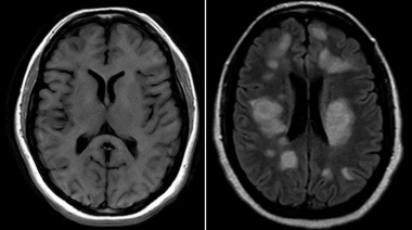 Cómo el uso de drogas impacta en el cerebro: Neuronas “exprimidas” y envejecimiento prematuro para el GPS del organismo