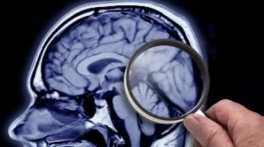 Descubrieron el segundo caso de una persona resistente al Alzheimer: Qué significa