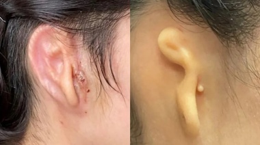 Una mujer recibió un trasplante de oreja impresa en 3D hecha con sus propias células