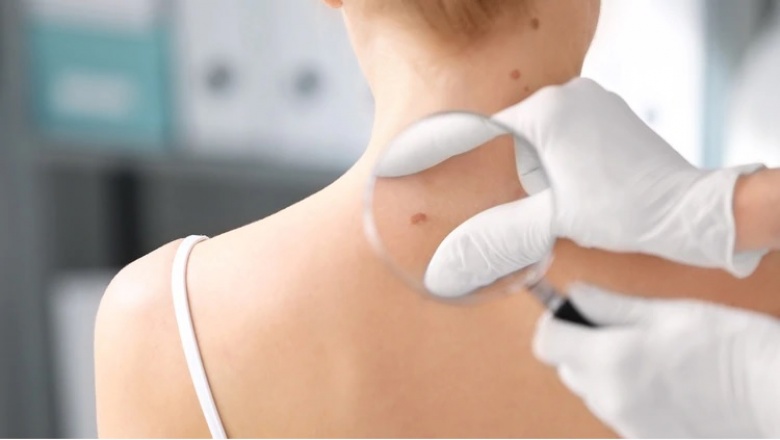 En la Argentina se diagnostican por año cerca de 130 mil casos de melanoma