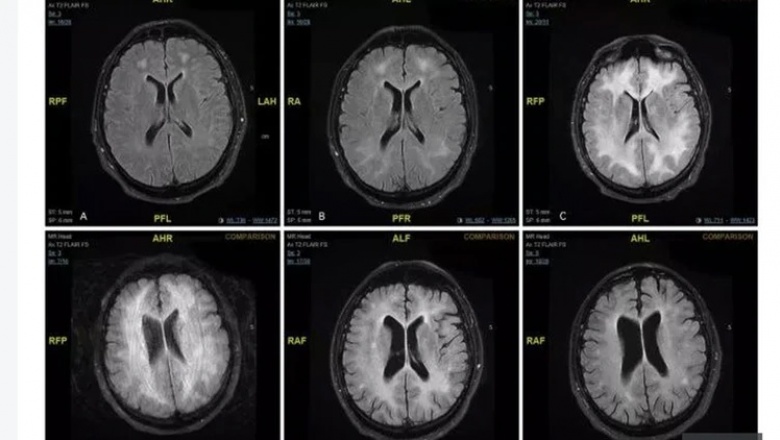 Revelan imágenes de cómo la cocaína "come" el cerebro de un adicto