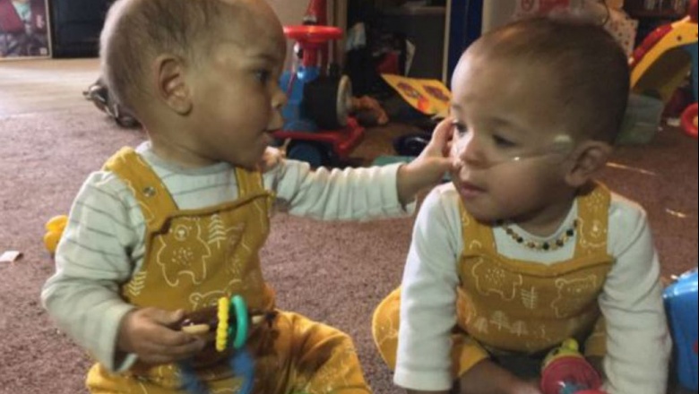 El bebé prematuro gravemente enfermo que mejoró en la incubadora luego del abrazo de su hermanito gemelo