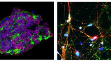 Detectan por primera vez las huellas tempranas del Parkinson en el cerebro humano