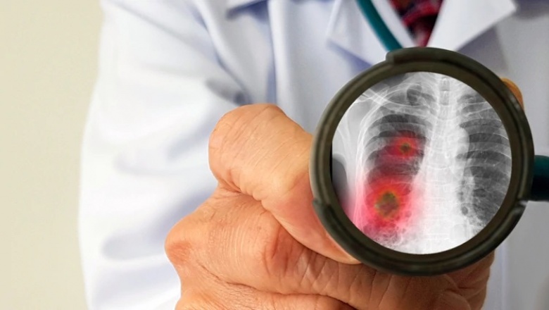 Qué dice la teoría sobre la alteración de la hemoglobina como la verdadera causa de neumonía por coronavirus