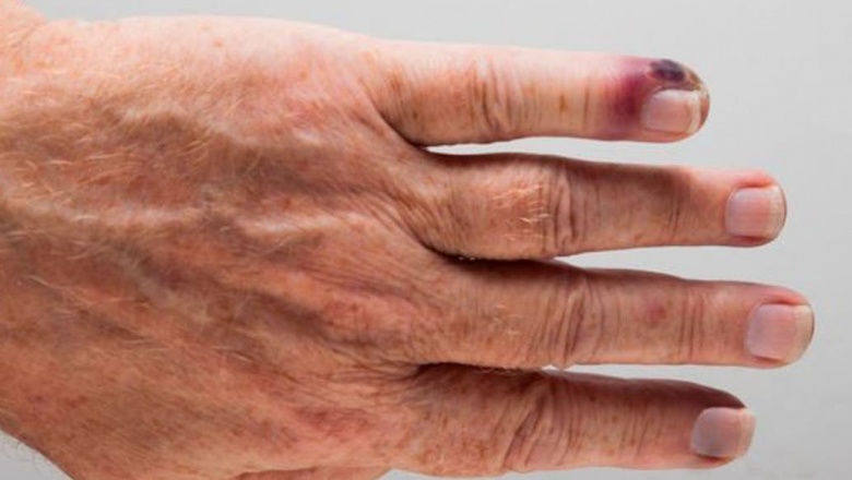 Septicemia, la enfermedad que mata anualmente a más personas que el cáncer en el mundo