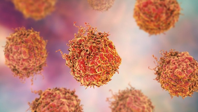 Los controles tempranos elevan las tasas de sobrevida del cáncer de próstata a más del 80%