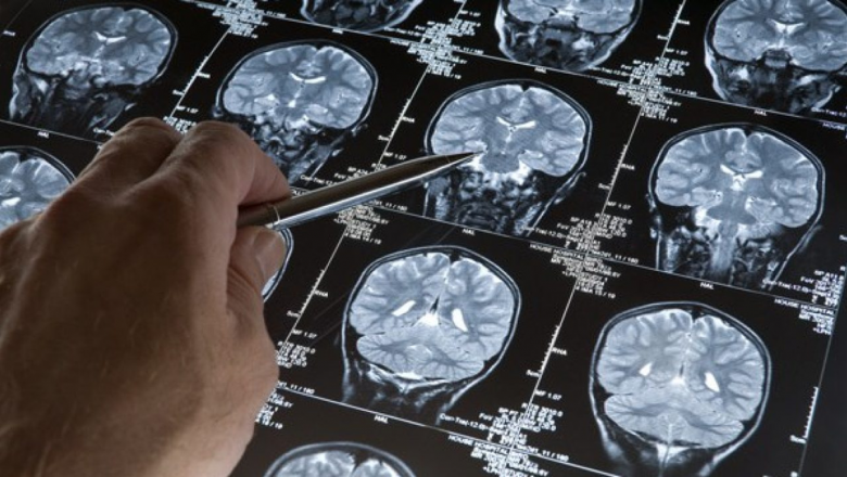 Alzheimer: Descubren lo que causa la muerte de células cerebrales y la demencia