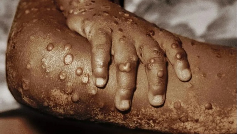 La era de los virus. Cómo afectan en el país los patógenos globales