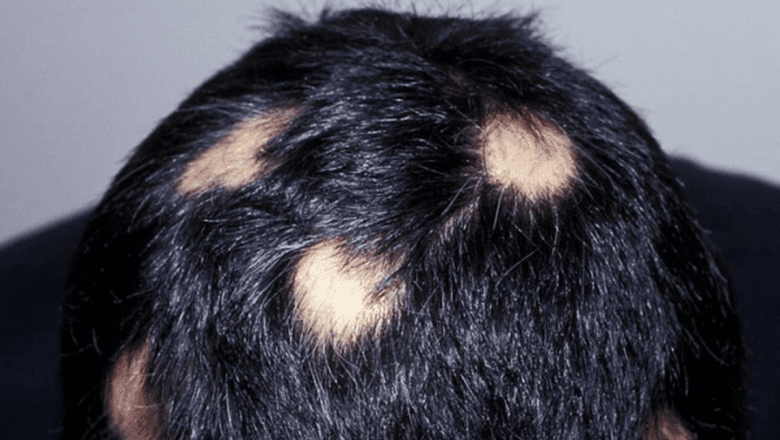 Alopecia: Prueban una pastilla para hacer crecer el pelo
