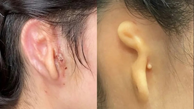 Una mujer recibió un trasplante de oreja impresa en 3D hecha con sus propias células