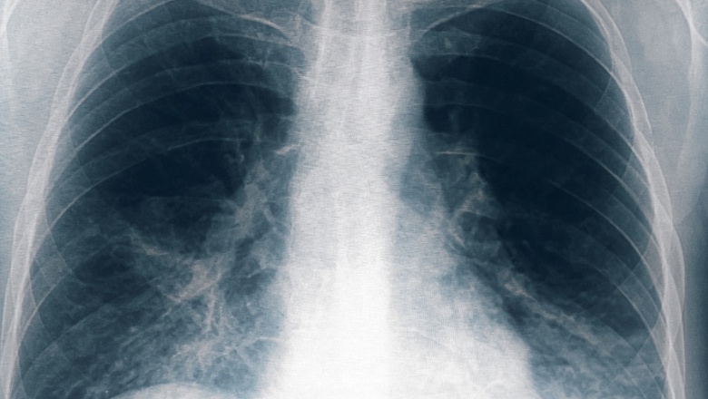 Neumonía bilateral por legionella: Ocho nuevos casos en Tucumán