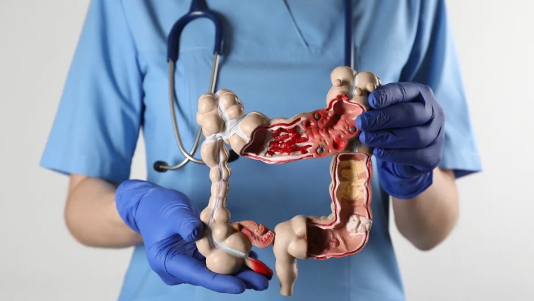 Identifican las células malignas que se desprenden del cáncer de colon y provocan las muertes por metástasis
