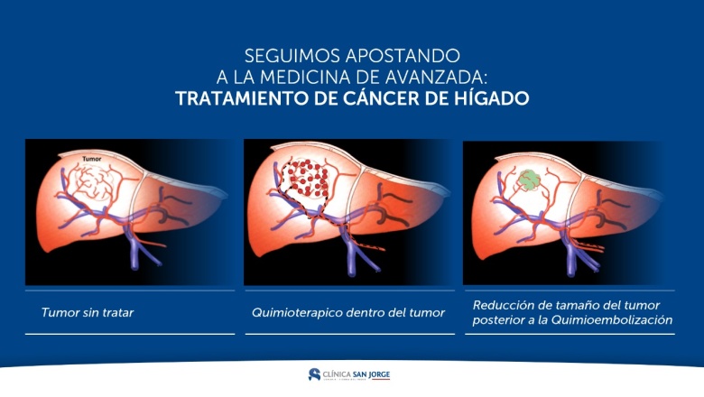 Clínica San Jorge implementó nuevo tratamiento oncológico