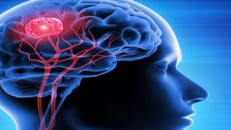 Cerebro: Un estudio reveló nueva información sobre el Parkinson