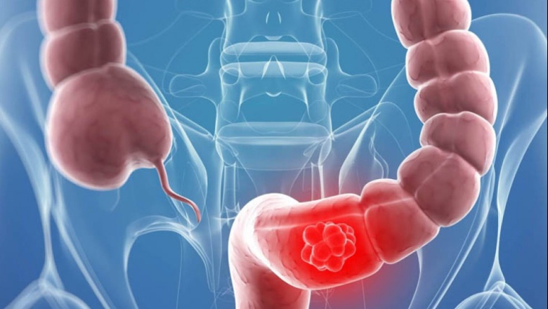 Río Grande lanzó la Campaña de Prevención de Cáncer de Colon