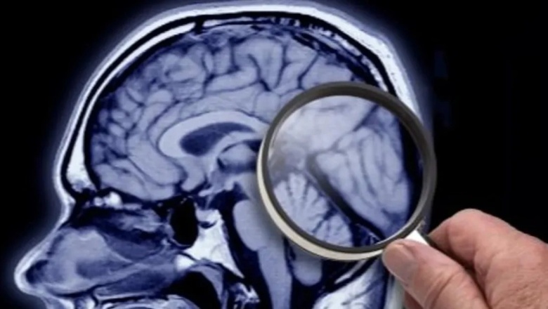 Descubrieron el segundo caso de una persona resistente al Alzheimer: Qué significa