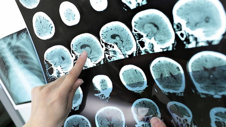 Nuevas pistas para la identificación temprana de Alzheimer