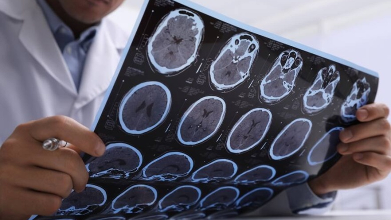 Alzheimer: descubren que los tests de sangre lo detectan con 90% de precisión