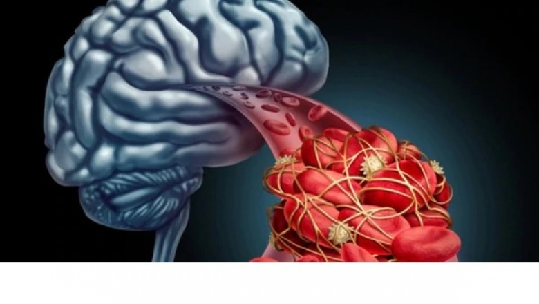 Un ataque de ACV mata 2 millones de neuronas por minuto