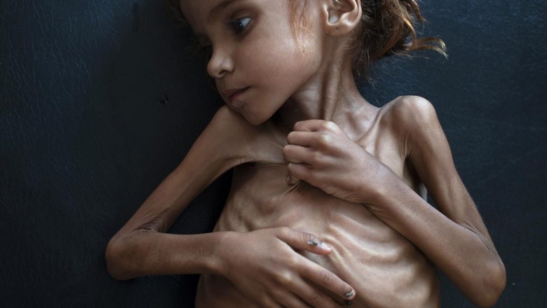 Murió Amal, la chica que se convirtió en un símbolo de la guerra y la hambruna en Yemen