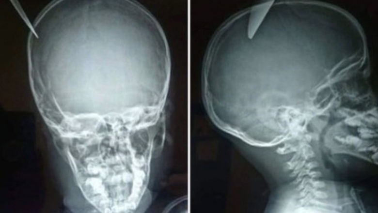 Un nene le clavó un cuchillo en el cráneo a su amigo de 5 años y se salvó de milagro
