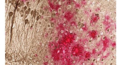 Una vacuna de ADN reduce las proteínas tóxicas asociadas al alzhéimer