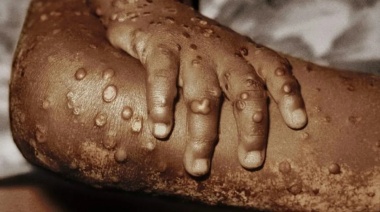 La era de los virus. Cómo afectan en el país los patógenos globales