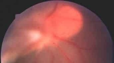 Se llevó adelante con éxito una cirugía de retinopatía en un prematuro