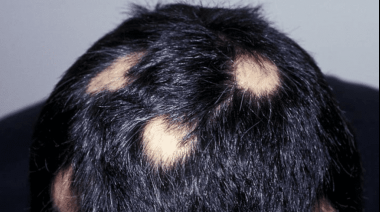 Alopecia: Prueban una pastilla para hacer crecer el pelo