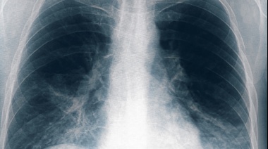 Neumonía bilateral por legionella: Ocho nuevos casos en Tucumán