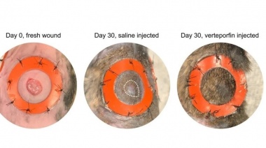 Las cirugías sin cicatrices serían una realidad posible