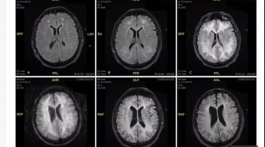 Revelan imágenes de cómo la cocaína "come" el cerebro de un adicto