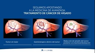Clínica San Jorge implementó nuevo tratamiento oncológico