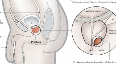 Cáncer de próstata: cuándo hay que empezar a hacerse los controles