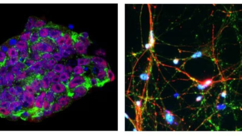 Detectan por primera vez las huellas tempranas del Parkinson en el cerebro humano