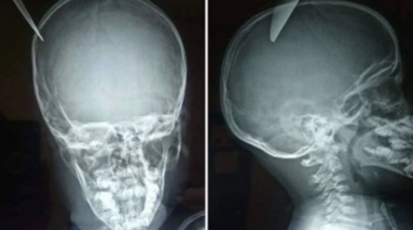 Un nene le clavó un cuchillo en el cráneo a su amigo de 5 años y se salvó de milagro