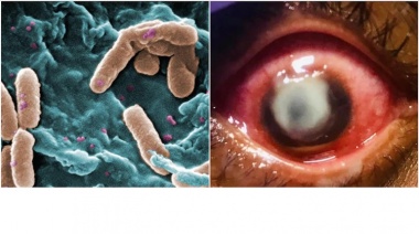 Infección por pseudomonas  la razón para no dormir con lentes de contacto: i