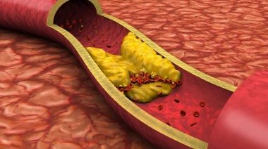 Tener el colesterol malo demasiado bajo podría disparar un ACV