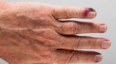 Septicemia, la enfermedad que mata anualmente a más personas que el cáncer en el mundo