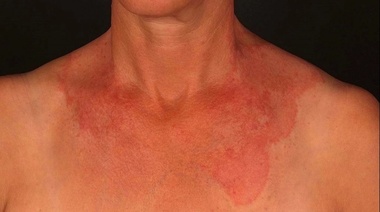 Psoriasis, la enfermedad que explotó en la pandemia