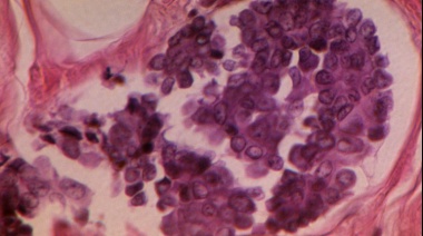 Cómo es el tratamiento sin quimio que promete extender la vida de mujeres con cáncer de mama metastásico