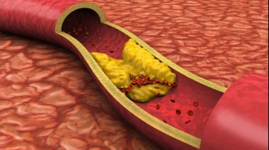 Un vínculo inesperado: La médula ósea explicaría el origen de la aterosclerosis y las enfermedades del corazón