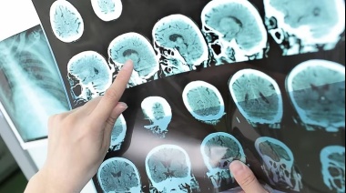 Avance clave contra la esclerosis múltiple: un tratamiento con células madre podría frenar la progresión de la enfermedad