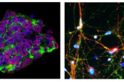 Detectan por primera vez las huellas tempranas del Parkinson en el cerebro humano